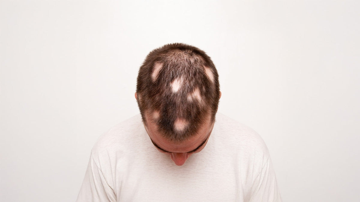Immagine che rappresenta un uomo con alopecia