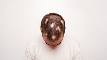 Immagine che rappresenta un uomo con alopecia