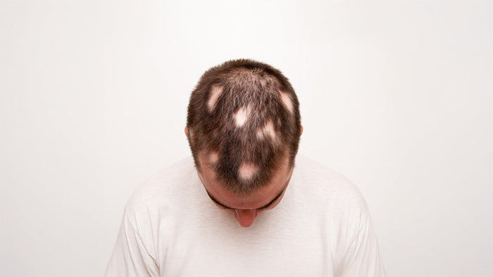 Immagine che rappresenta un uomo con alopecia