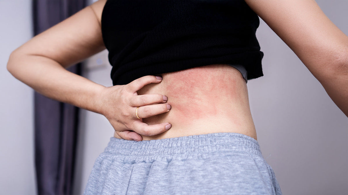 Immagine che raffigura una donna con pelle arrossata e dermatite