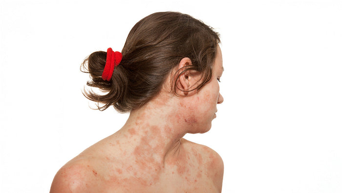 Immagine che rappresenta una donna con dermatite atopica