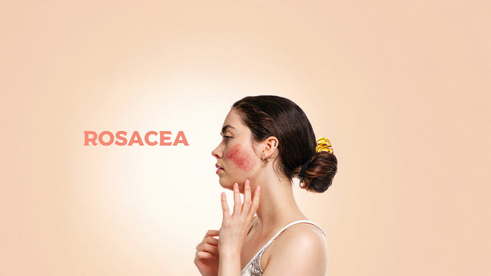 Immagine che raffigura una donna con rosacea