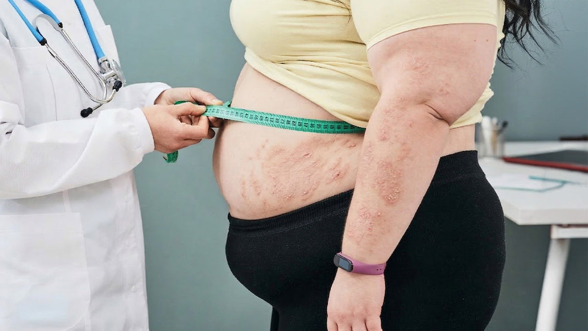 Immagine che rappresenta una donna obesa con dermatite atopica