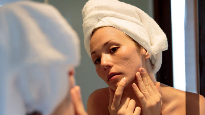 Immagine che raffigura una donna con acne