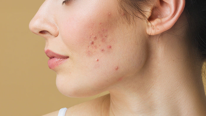 Immagine che raffigura una donna con acne