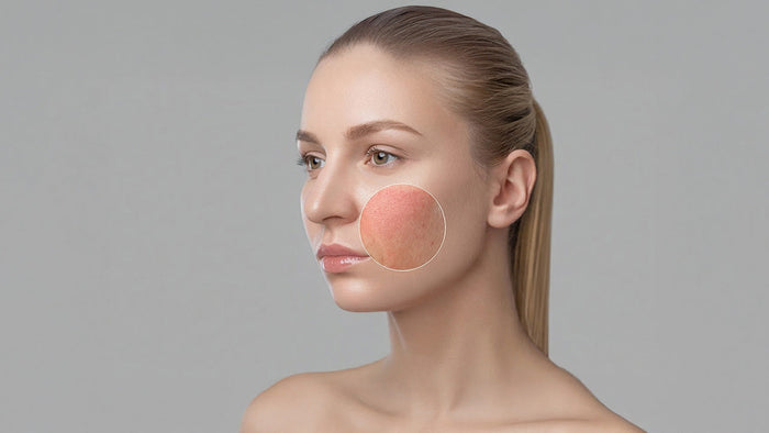 Immagine che raffigura una donna con pelle irritata