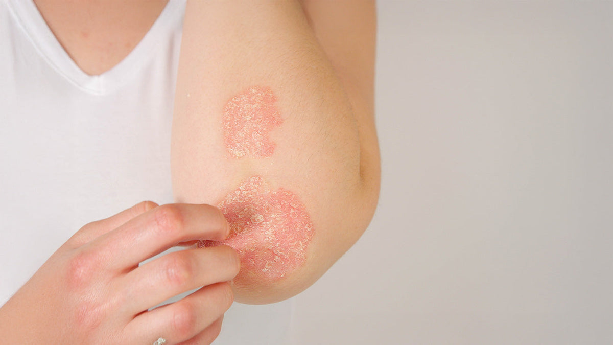 Immagine che raffigura una donna con psoriasi